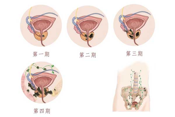 前列腺癌 前列腺癌